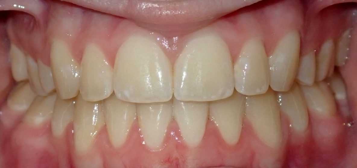 Vivid Smiles patient case 15 before and after treatment comparison after